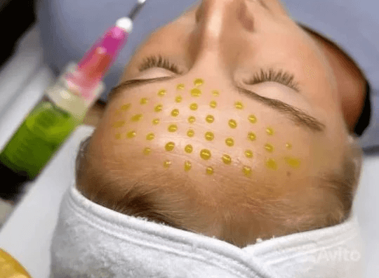 Пилинги всесезонные: молочный, азелаиновый.,миндальный, гликолевый, энзимный, белый ,зеленый двухфазный